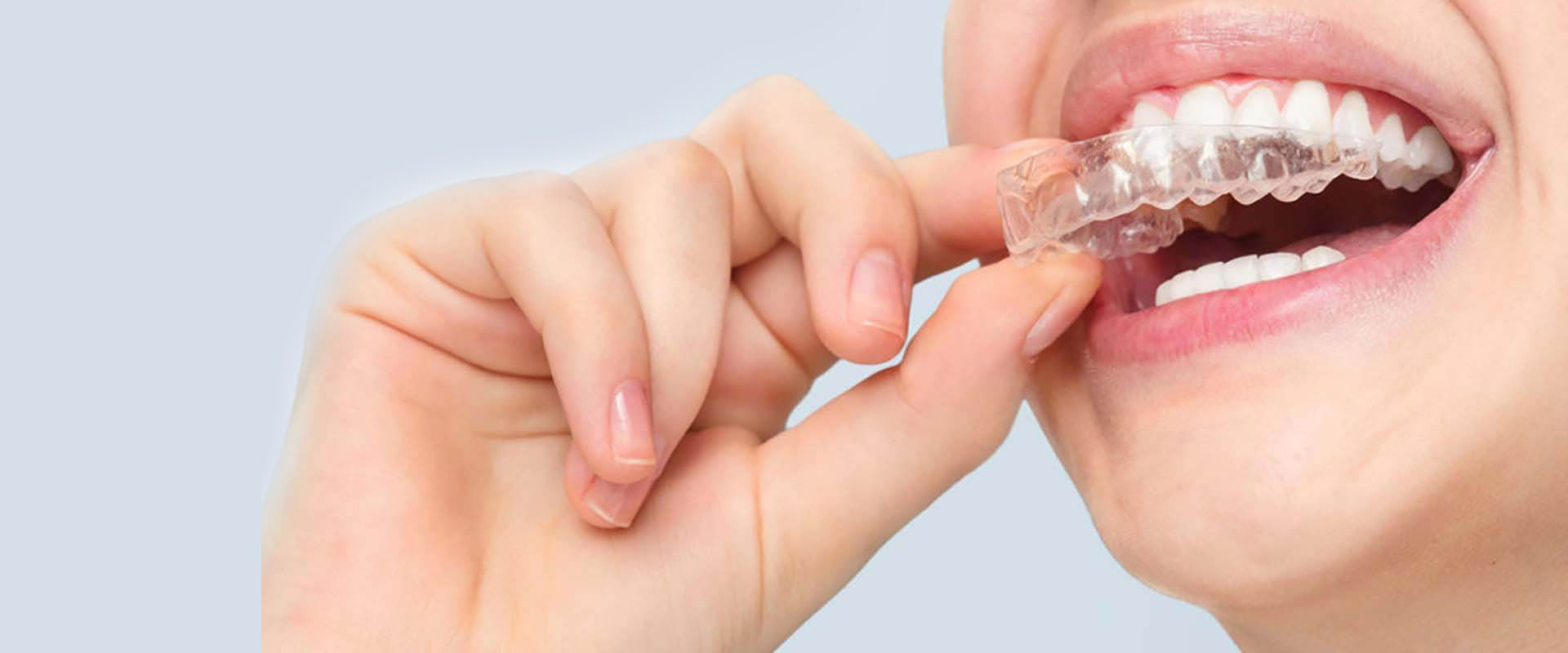 İNVİSALİNG TEDAVİSİ İNVİSALİNG TEDAVİSİ