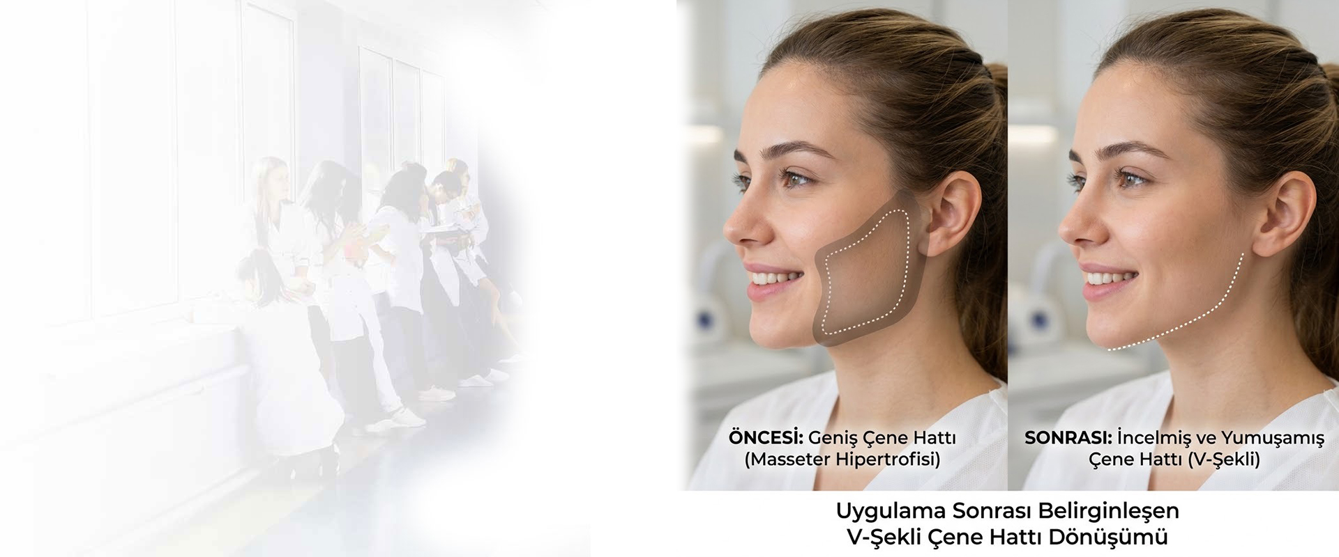 Masseter Botoksu ile Estetik ve Sağlık Bir Arada